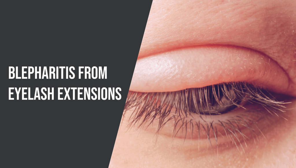 Blepharitis from Eyelash Extensions