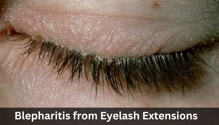 Blepharitis from Eyelash Extensions