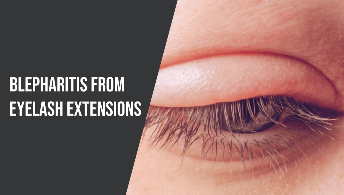 Blepharitis from Eyelash Extensions The Lash Professional