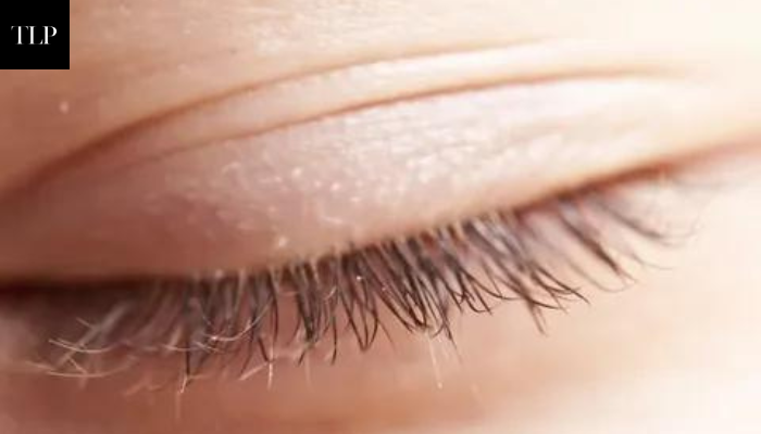 How Do You Get Rid of Lash Mites?