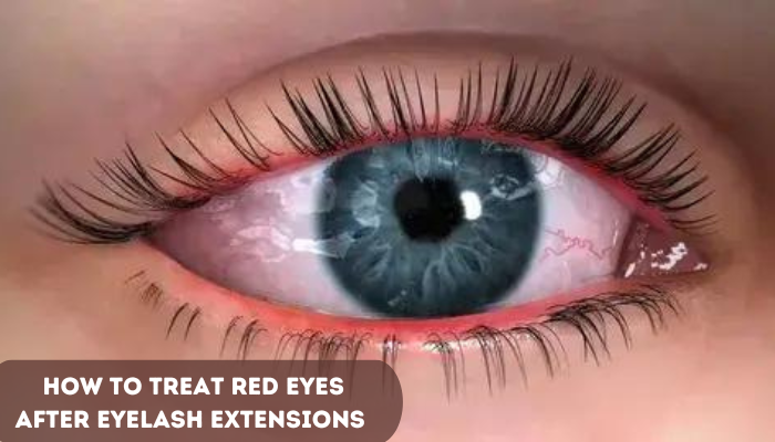 How to Treat Red Eyes After Eyelash Extensions?